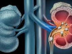 Drink more Water for Healthy Kidneys, Experts Urge Nigerians
